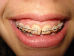 Modern braces, 2008