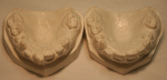 Plaster cast of upper teeth before and after brace, 1934