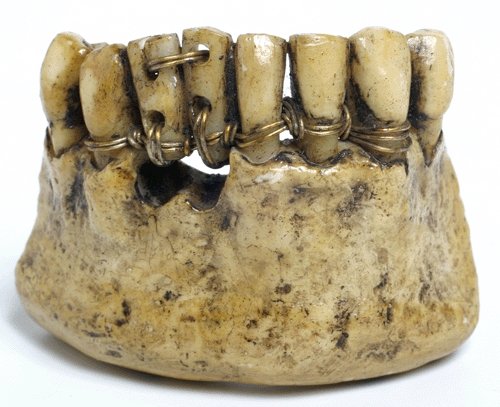 Transplantation Of Teeth. Etruscan teeth, around 2000