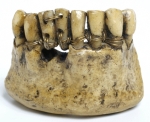 Etruscan teeth, around 2000 years old, courtesy of Surgeon's Hall Museum, RCS Edinburgh