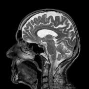 An MRI scan of a normal brain